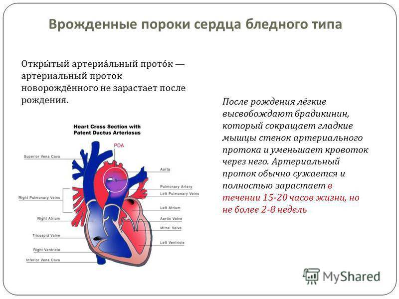 Малые аномалии развития сердца -