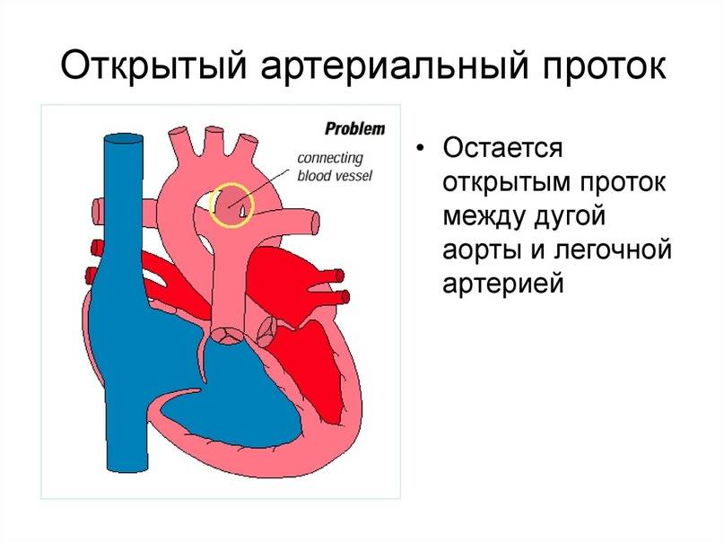 Открытый артериальный проток :: polismed.com