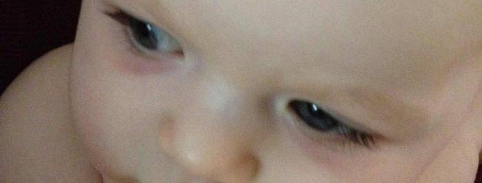 Синяки под глазами у грудничка: причины, почему у новорожденых появдяются темные круги, советы родителям