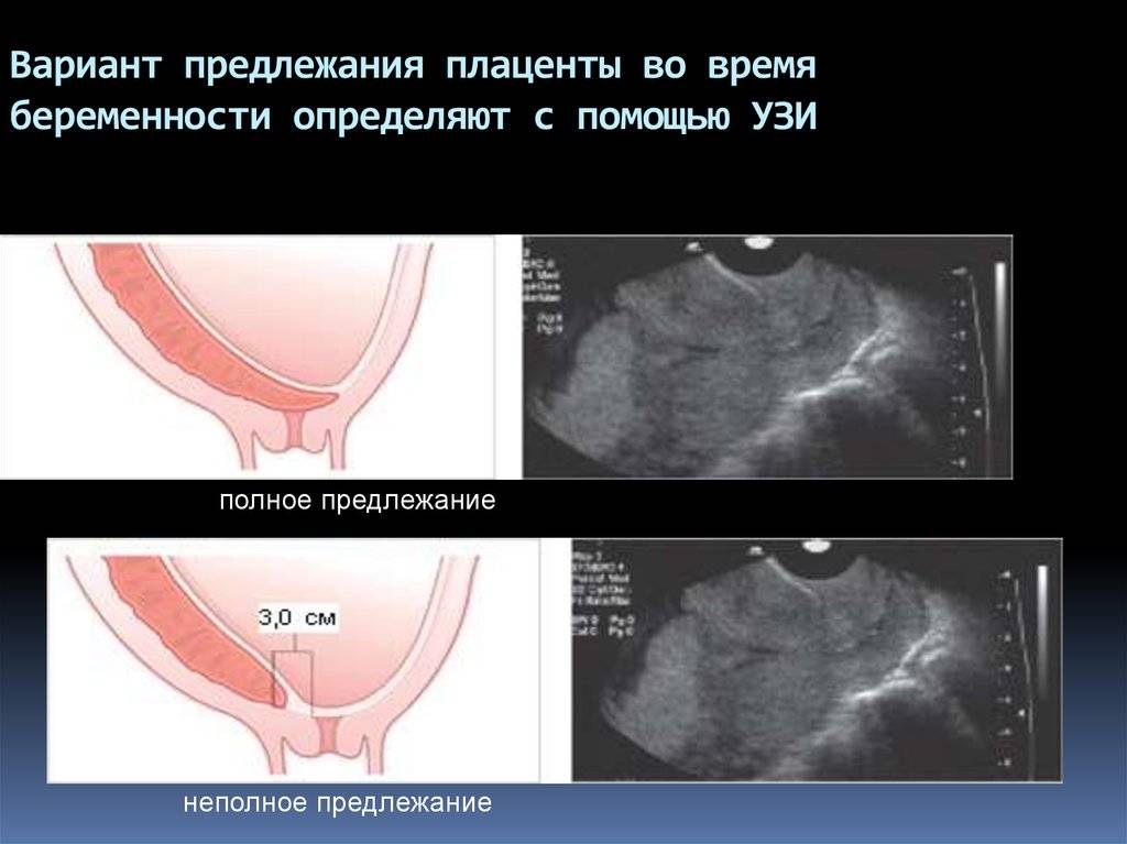 Ретрохориальная гематома при беременности, выделения, гематома в матке, размер, лечение и причины