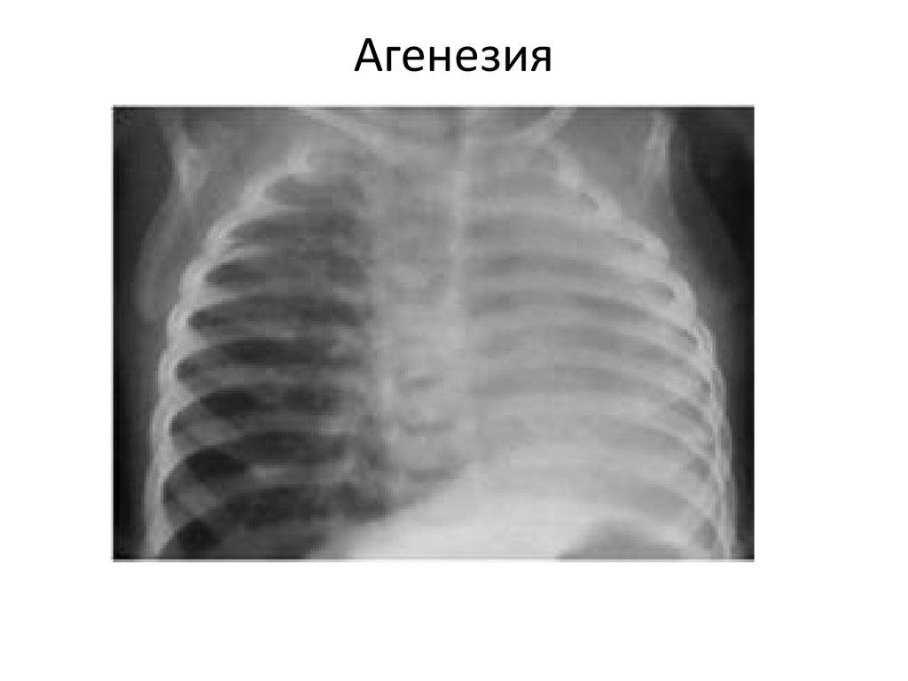 Пренатальное и постнатальное развитие и рост лёгкого. анатомия и физиология дыхательной системы. заболевания органов дыхания у детей |