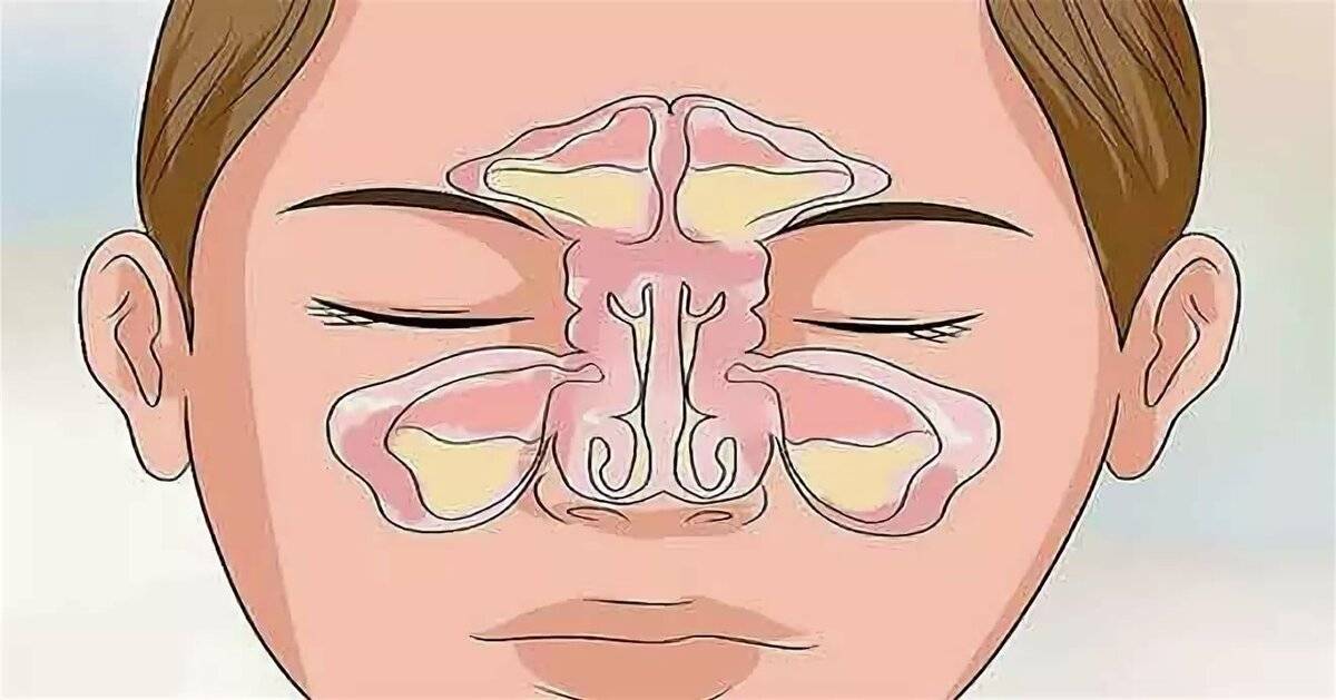 Причины и лечение заложенности носа без насморка