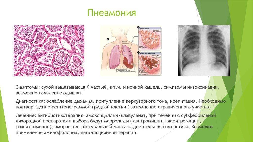 Крупозная пневмония у детей - симптомы болезни, профилактика и лечение крупозной пневмонии у детей, причины заболевания и его диагностика на eurolab
