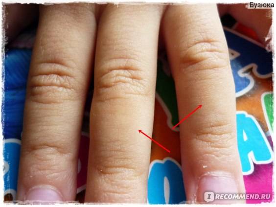 Дети грызут ногти: последствия и как отучить