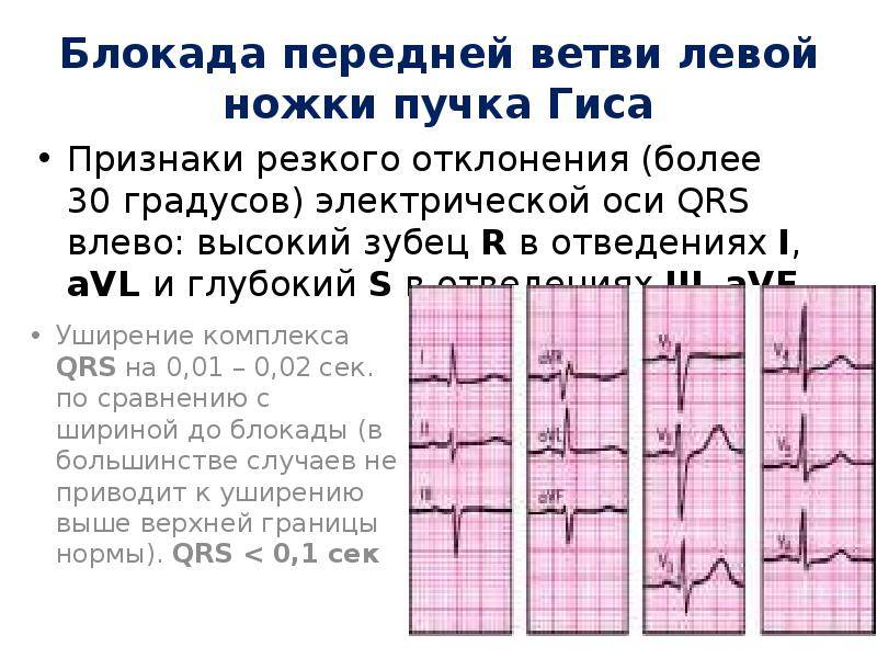 Блокады правой и левой ножек пучка. Диагноз блокада левой ножки пучка Гиса. Блокада ПНПГ на ЭКГ.