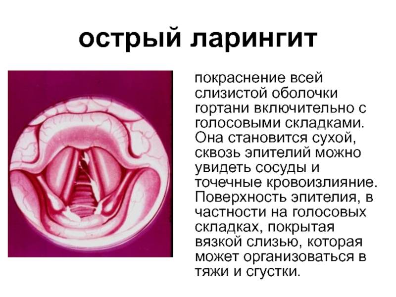 Лечение острых заболеваний горла и гортани | медицинский дом odrex