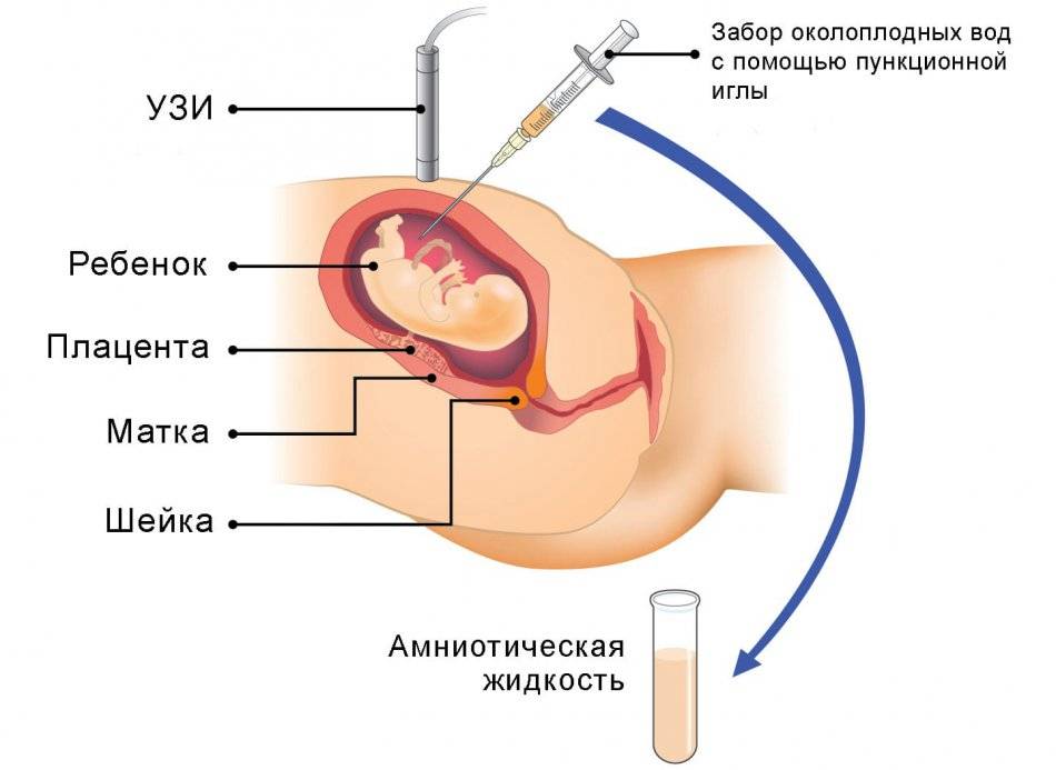 Скрининг 1 триместра беременности