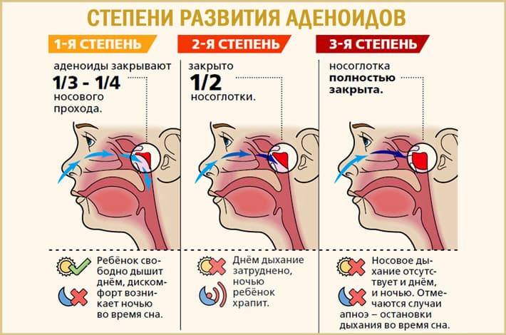 Доктор Комаровский о лечении аденоидов 3 степени без операции