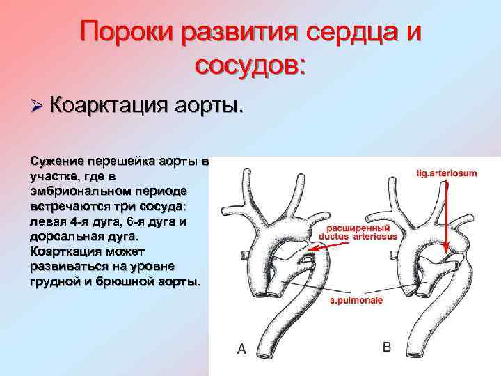 Коарктация аорты: симптомы, диагностика, лечение | компетентно о здоровье на ilive