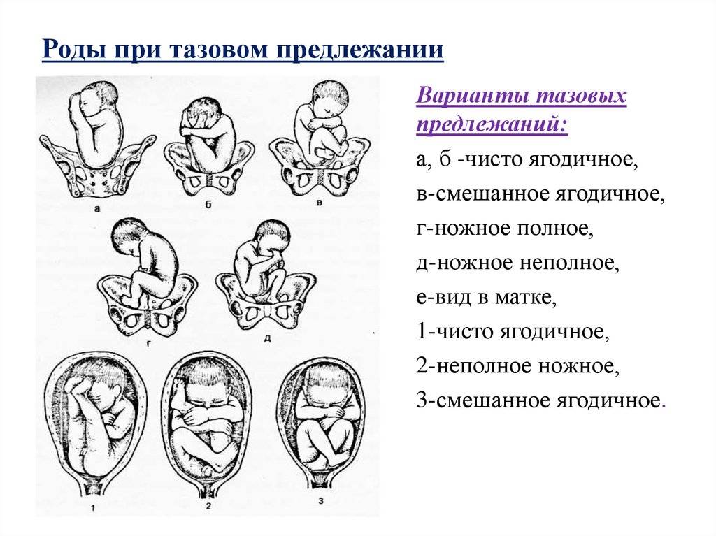 Головное предлежание плода при беременности фото