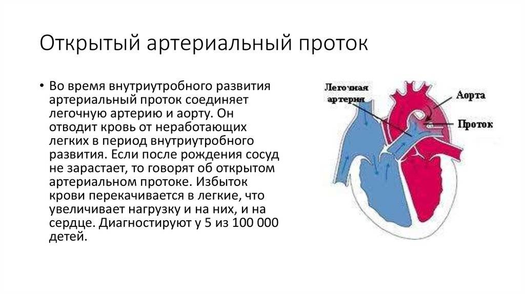 Кт и мрт диагностика открытого артериального протока сердца у детей