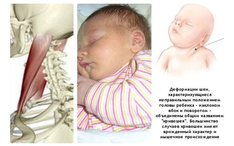 Лечение кривошеи у новорожденных, кривошея у ребенка 3 месяца