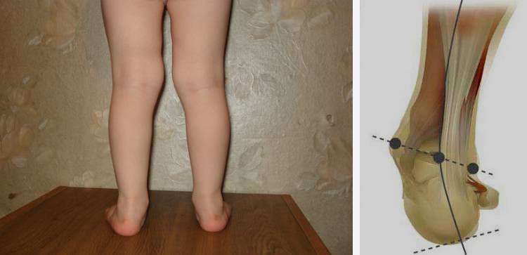 Особенности ортопедических стелек для детей при лечении вальгусной деформации стоп