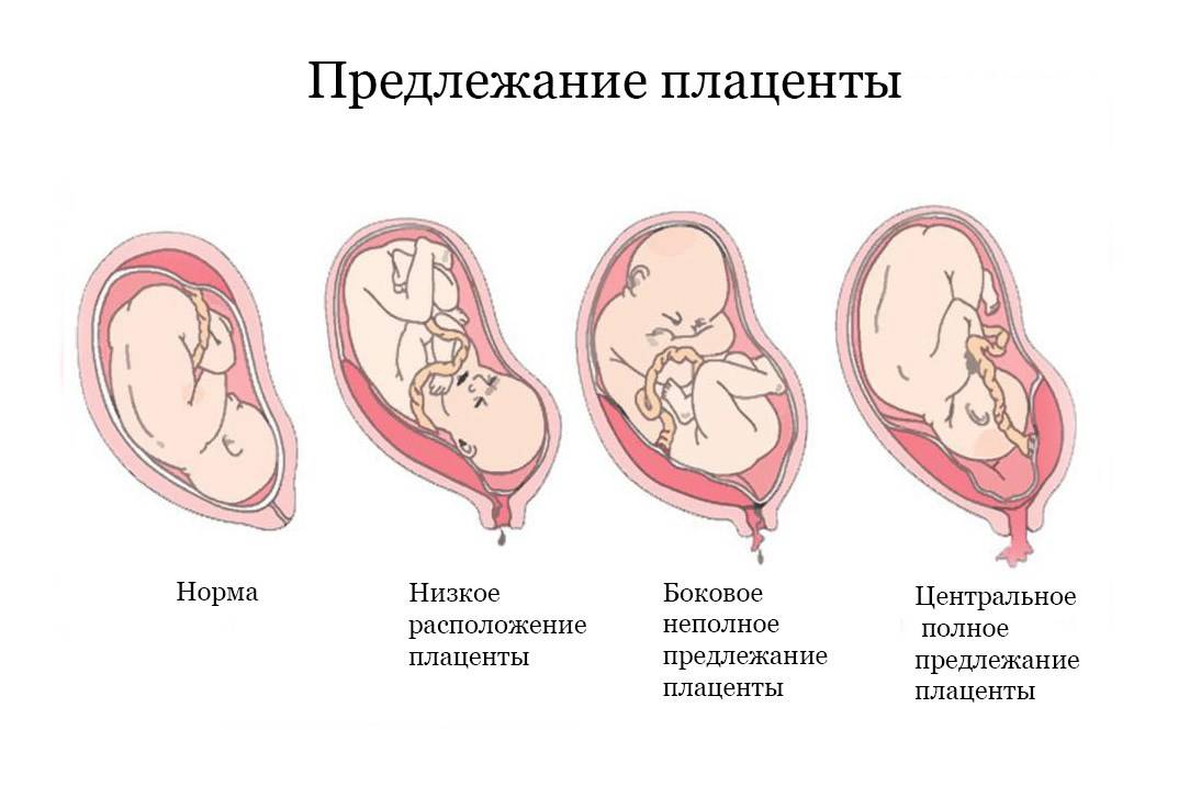 Предлежание плаценты: «безвыходная» беременность