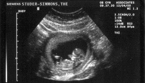 Сколько будет 11 недель. Как выглядит ребенок на УЗИ В 11 недель. 11 Недель беременности фото плода на УЗИ. УЗИ на 11 неделе беременности на УЗИ. Эмбрион на 11 неделе беременности УЗИ.