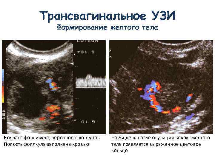 Как на узи выглядит овуляция фото