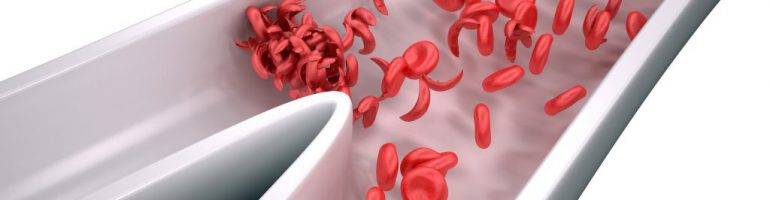 Сгустки крови в моче – симптом различных заболеваний у женщин и мужчин