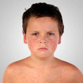 Синдром кавасаки у детей после covid-19. всё, что нужно знать