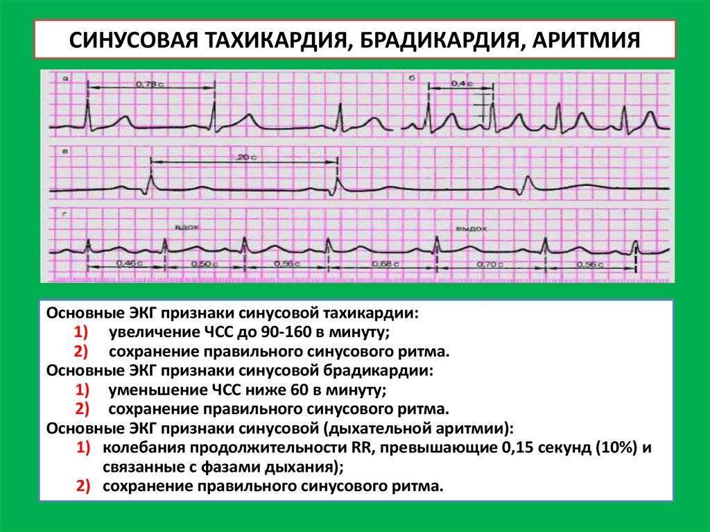 Брадикардия
