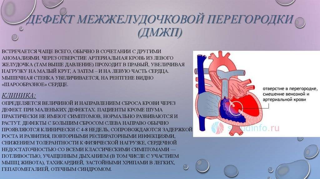 Спина бифида (расщепление позвоночника) - лечение, симптомы, причины, диагностика | центр дикуля