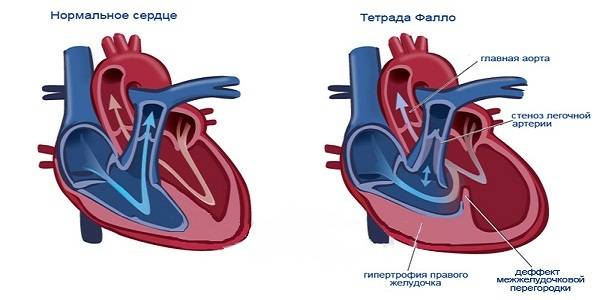 Тетрада фалло у детей