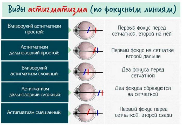 Разница между астигматизмом и близорукостью - энциклопедия ochkov.net