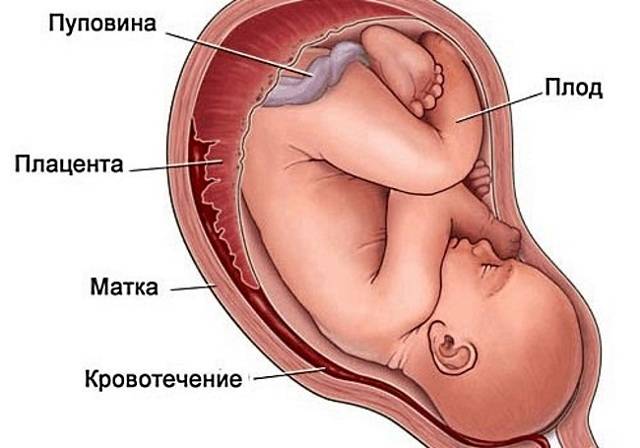 Ретрохориальная гематома при беременности: симптомы и лечение