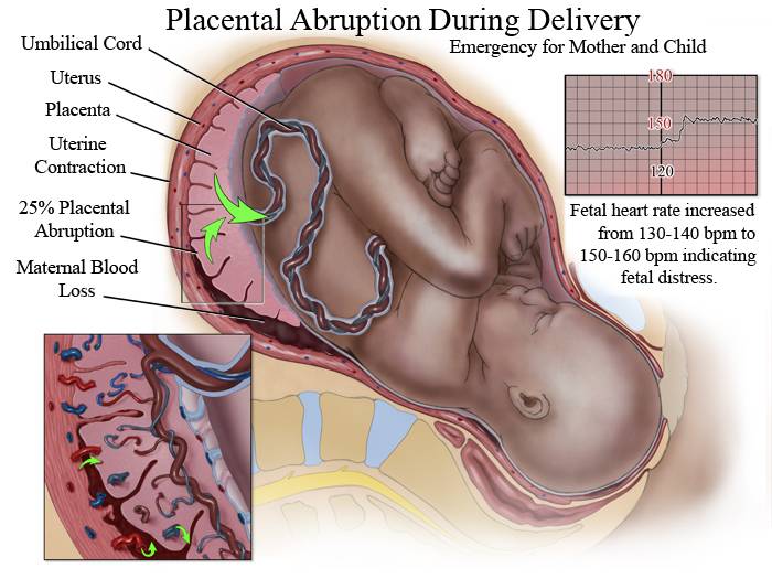 Отслойка плаценты | eurolab | гинекология