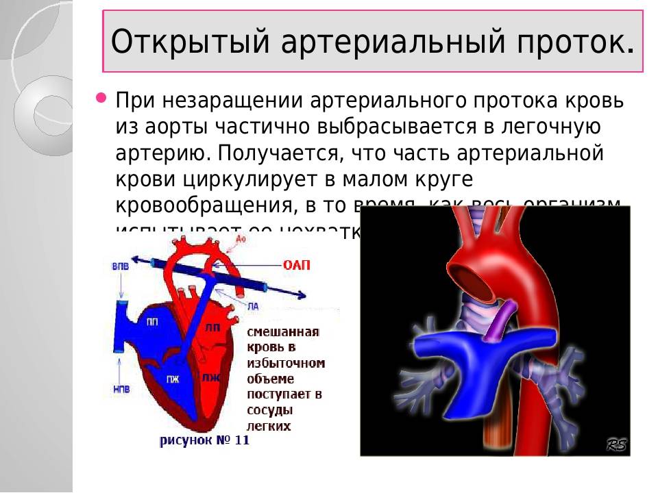 Оап у новорожденных. Открытый артериальный проток Баталов. Боталлов проток гемодинамика. Незаращение артериального протока. Открытый боталлов проток сердца.
