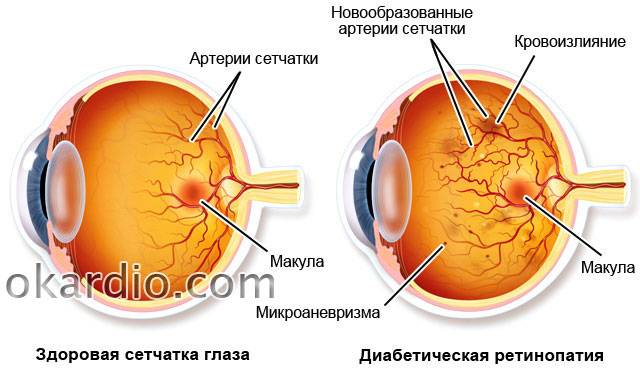 Сосудистые заболевания оболочки глаз, методы лечения