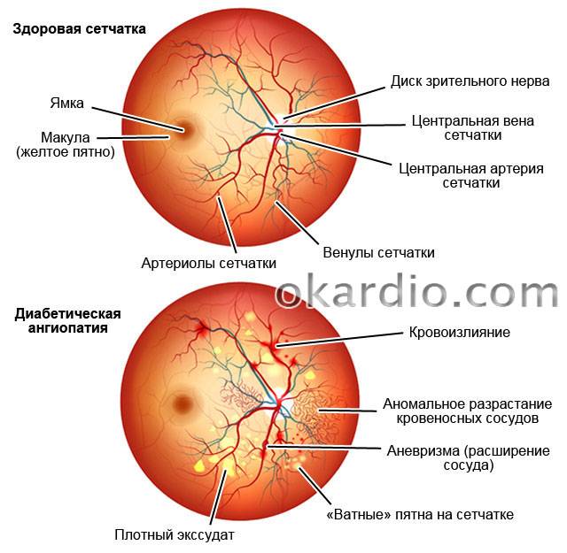 Что такое ишемическая оптическая нейропатия у новорожденных и как она проявляется?