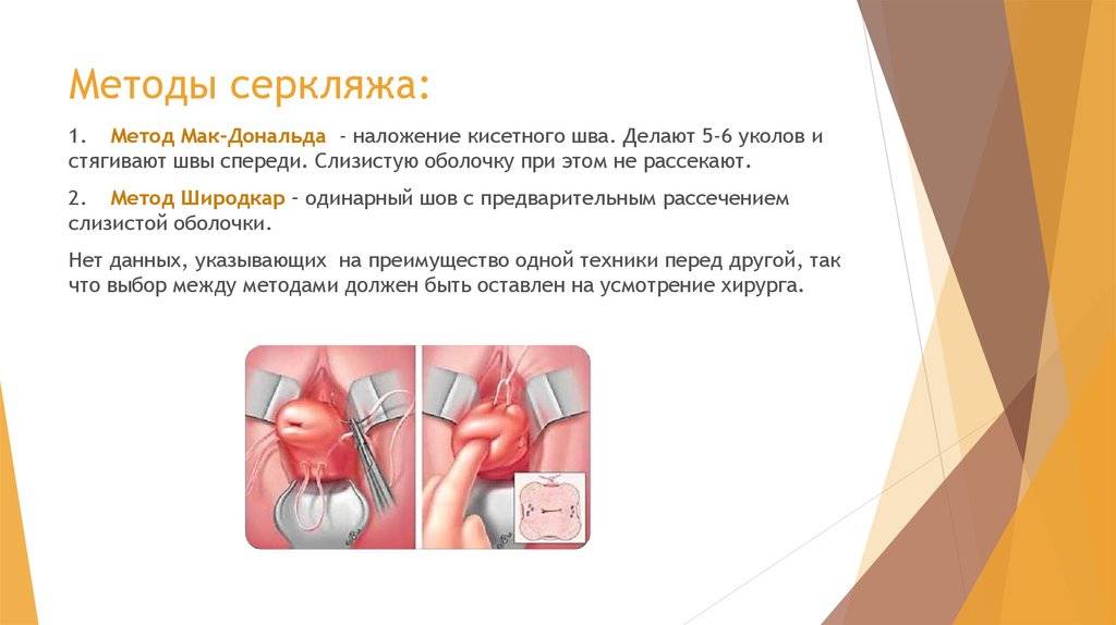 Шов на шейке матки. Серкляж (наложение швов на шейку матки). Швы на шейку матки при ИЦН. Наложение шва по Макдональду.