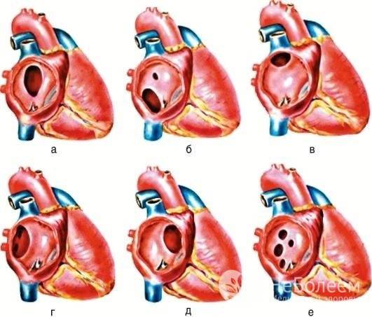 Дефект межпредсердной перегородки сердца у детей (ДМПП) – аневризма сердца