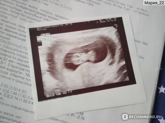 Пол ребенка на узи на 18 неделе беременности: фото, показатели, нормы