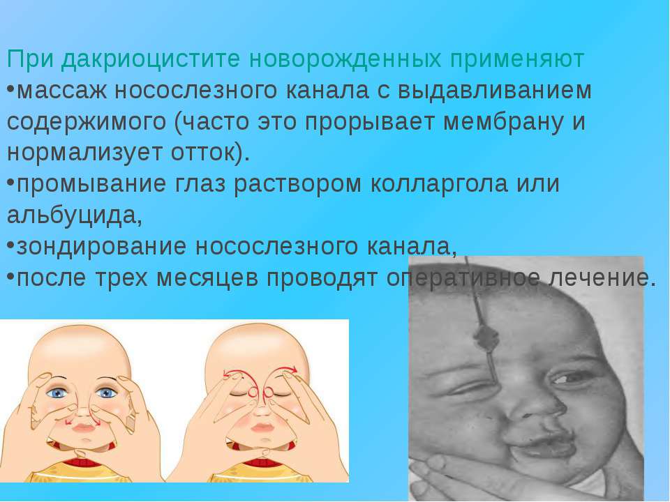 Массаж при дакриоцистите новорожденных: как правильно делать и какой схемы следует придерживаться при данном виде лечения