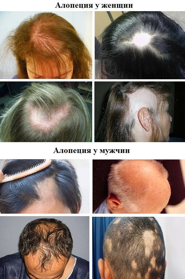 Типы выпадения волос у женщин
