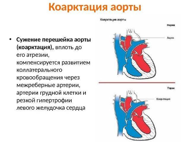 Коарктация аорты у детей и новорожденных