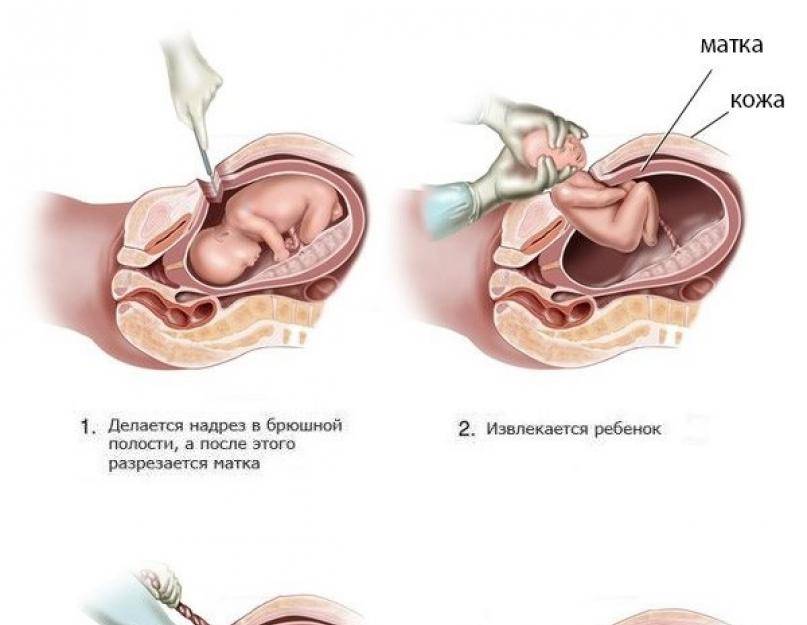 Беременность после кесарева сечения: через сколько месяцев можно снова беременеть и рожать
