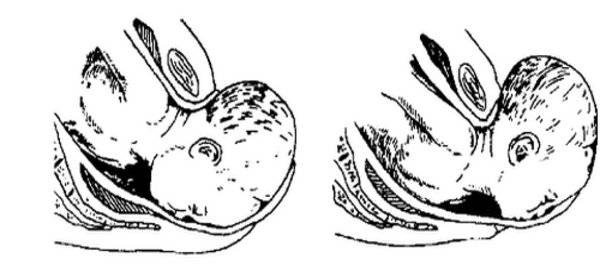 Что такое задние и передние типы затылочных предлежаний плода и на что они влияют?