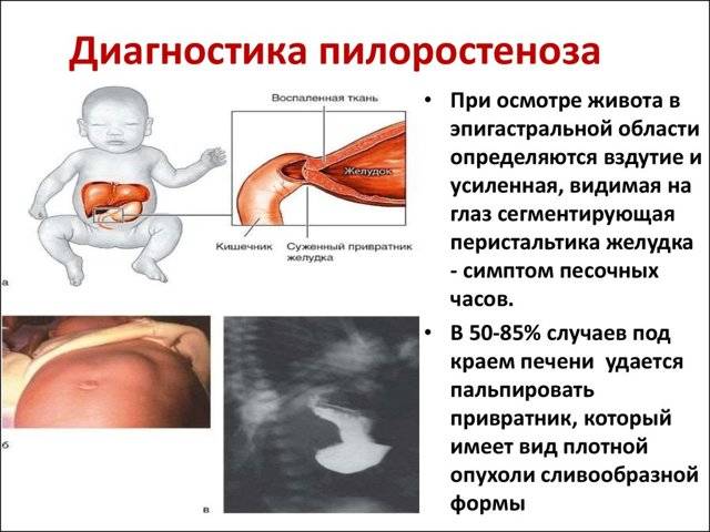 Дисбактериоз и срыгивание у детей - сибирский медицинский портал