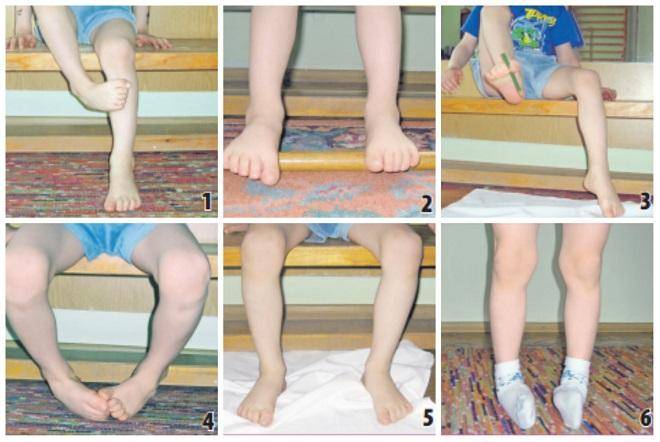 Вальгусная деформация стопы у детей