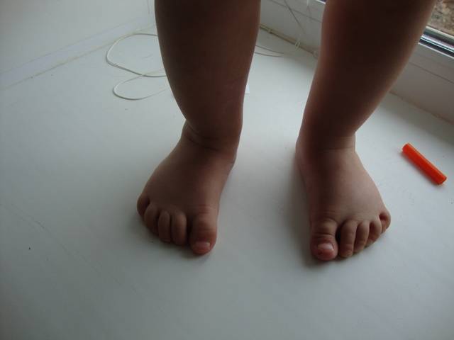 Ребенок хромает на одну ногу: причины, что делать, если ребенок подвернул ногу, после пентаксима, почему стал хромать после сна