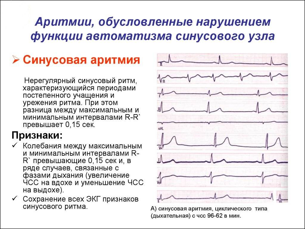 Аритмия у детей и подростков: основные причины, профилактика, лечение нарушений ритма сердца у детей - yod.ua