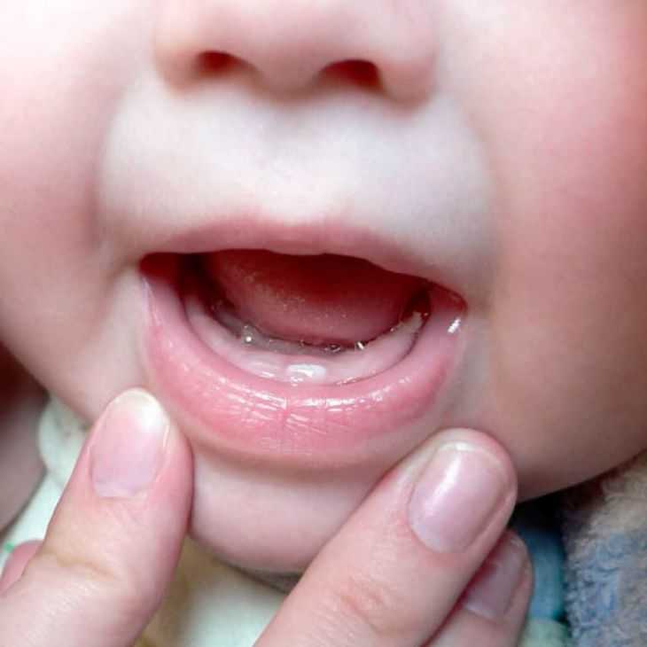 Сколько длится понос у грудничка при прорезывании зубов и нужно ли его лечить