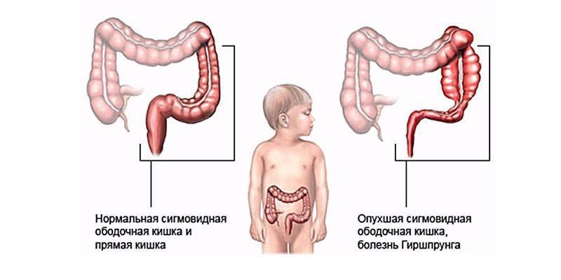 Синдром раздраженного кишечника (срк): симптомы и лечение – напоправку