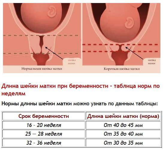 Узи шейки матки (цервикометрия) | университетская клиника