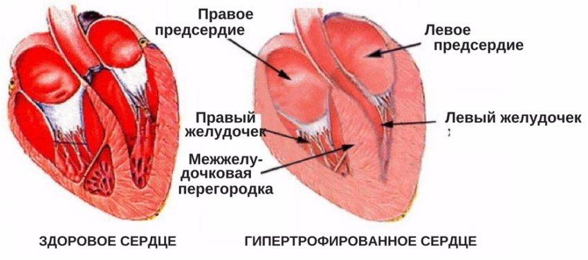 Ревматическое поражение сердца на эхокардиографии