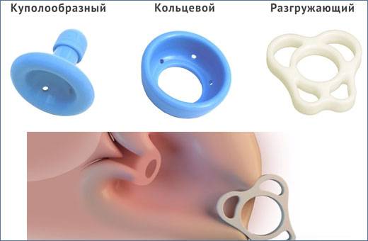 Применение акушерского силиконового пессария куполообразной формы у беременных с предлежанием плаценты как метод профилактики ранних преждевременных родов