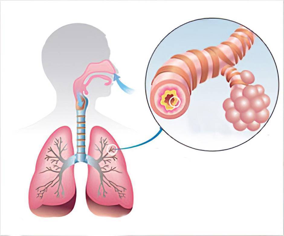 Заболевания дыхательных путей и их профилактика